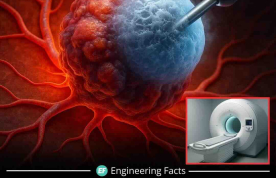 Máy MRI đông lạnh khối u đầu tiên ở Úc: Giải pháp không phẫu thuật, giảm đau nhanh chóng